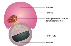 Klinik für Prostata-Therapie Heidelberg: Weniger ist oft mehr: Zu viele Prostata-Krebspatienten leiden unter einer Übertherapie / Neue Studie belegt die Nachteile von Skalpell und Bestrahlung