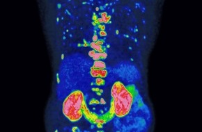 Universitätsklinikum Essen AöR: Neue Methode verbessert Prognose und Therapie von Prostatakrebs