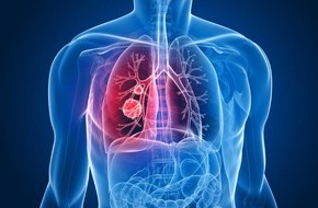 Novocure GmbH: Neue Option für Lungenkrebspatient:innen: Innovative Therapie mit elektrischen Wechselfeldern jetzt CE-zertifiziert