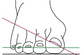 Asklepios Klinikum Bad Abbach: "Hallux valgus" -  Das schmerzhafte Problem mit dem großen Zeh