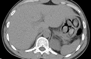 Hauptzollamt Köln: HZA-K: Mit Kokain im Bauch auf Reisen / Kölner ZOLL stellt niederländischen Körperschmuggler im Bus