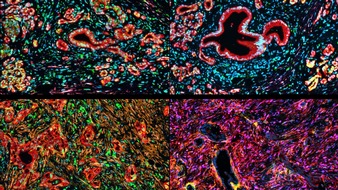 Universit&auml;t Duisburg-Essen: Millionenf&ouml;rderung f&uuml;r Bauchspeicheldr&uuml;senkrebs-Forschung: Smarte Daten verbessern die Behandlung