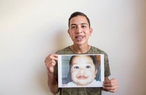 FDI World Dental Federation: La FDI et Smile Train lancent un projet visant à améliorer la santé buccodentaire des enfants présentant une fente labio-palatine, la différence congénitale la plus répandue du visage et de la bouche