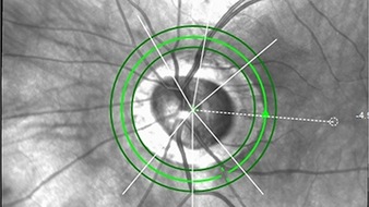 Technische Hochschule Köln: Grüner Star: Neues Verfahren zur Früherkennung. TH Köln entwickelt kostengünstiges Glaukom-Diagnosegerät
