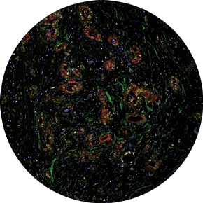 Millionenf&ouml;rderung f&uuml;r Bauchspeicheldr&uuml;senkrebs-Forschung