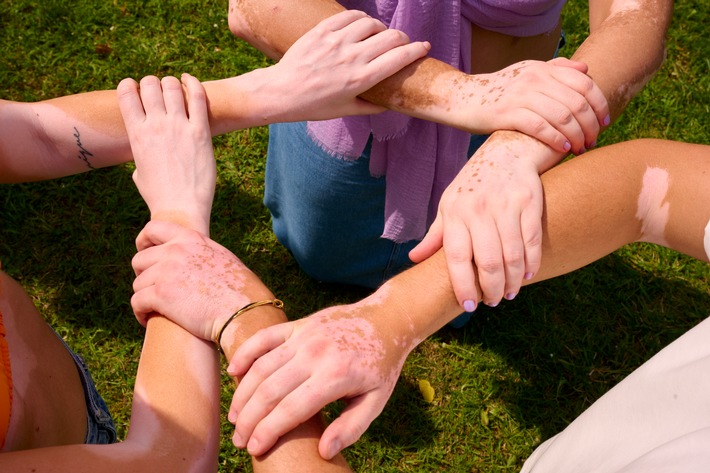 Die Feiertage genießen, auch mit Vitiligo: Warum die Weihnachtszeit Menschen mit Vitiligo besonders herausfordert