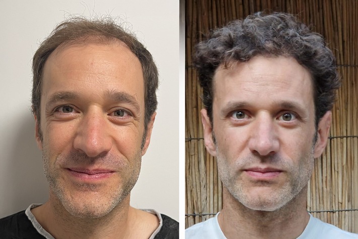 Haartransplantation Türkei Testsieger 2026: Die 10 besten Kliniken im großen Vergleich