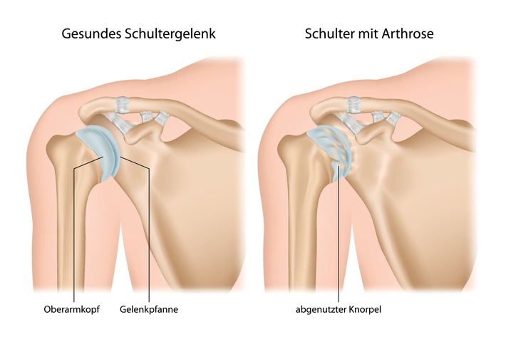 Arthrose in der Schulter