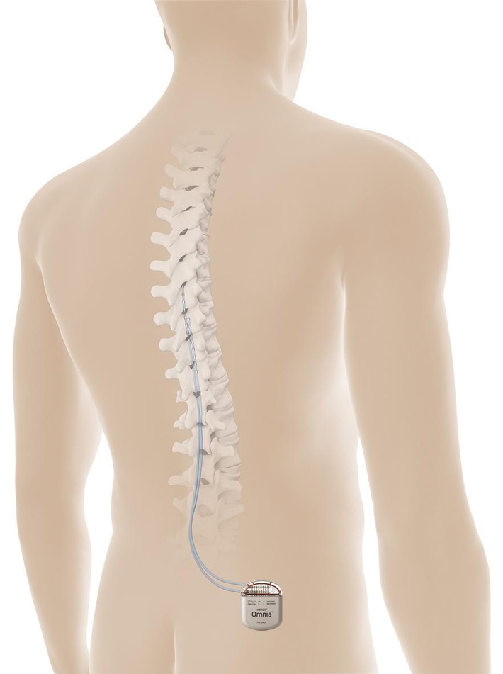 Rückenmarkstimulation wirksam bei therapierefraktärer schmerzhafter diabetischer Neuropathie