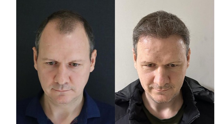 Die 10 Besten Haartransplantationskliniken in der Türkei - Kosten, Dauer & Erholungszeit