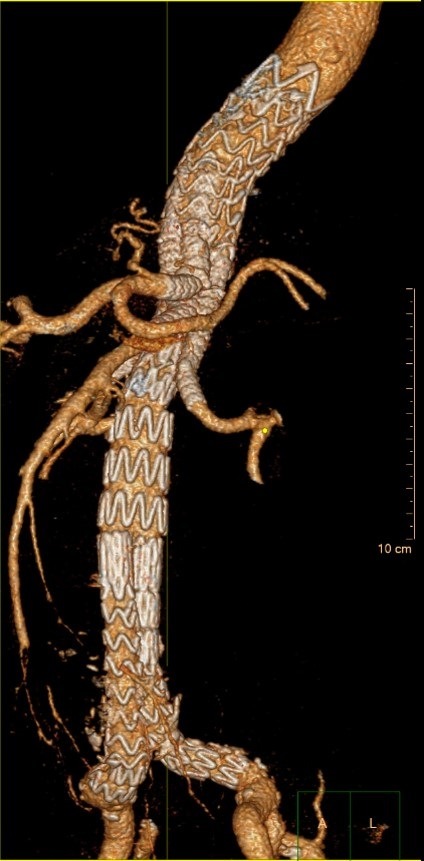 Europapremiere in der Gefäßchirurgie der Asklepios Klinik Nord - Heidberg: Erster Aorten-Aneurysma-Patient in Europa mit innovativer Therapie mittels High-End Stentgraft behandelt