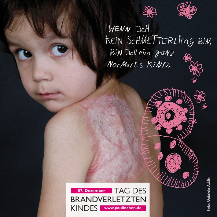 FW Weinheim: Tag des brandverletzten Kindes Gemeinsam Kraft geben, Prävention stärken