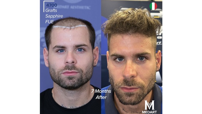 Die 10 besten Haartransplantationszentren in der Türkei: Kompletter Ratgeber für ausländische Patienten 2026