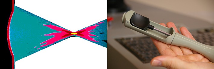 Fokale Therapie bei Prostatakrebs: Mit sicherer Diagnose schonend und erfolgreich behandeln (FOTO)