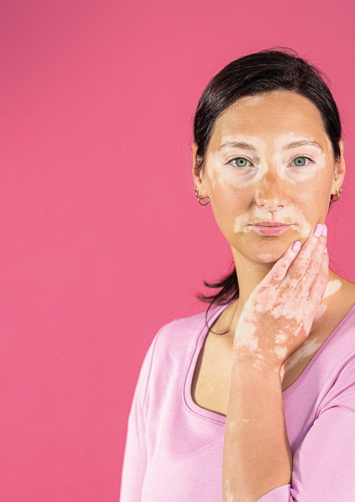 Welt-Vitiligo-Tag: Die Zeit ist reif - Für Betroffene mit Vitiligo lohnt sich ein Besuch beim Facharzt