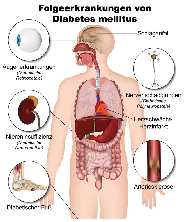 Naturheilverfahren in der Diabetes-Leitlinie empfohlen