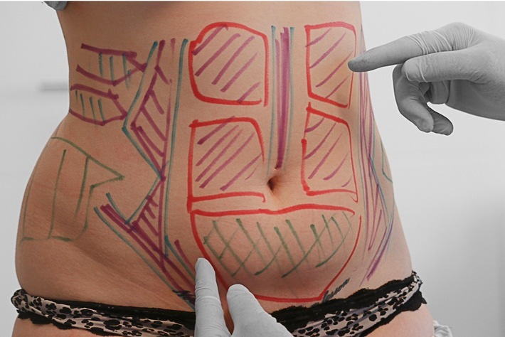 Mommy-Makeover bei Dr Altintas Weiterer Text über ots und www.presseportal.de/nr/143391 / Die Verwendung dieses Bildes ist für redaktionelle Zwecke honorarfrei. Veröffentlichung bitte unter Quellenangabe: "obs/Mc Aesthetics UG/@sylviakaduk www.sylviakaduk.de"