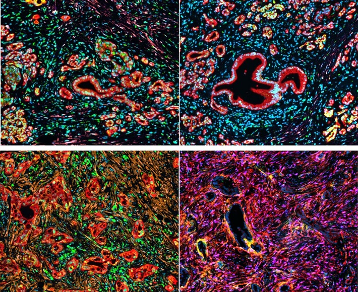 Millionenförderung für Bauchspeicheldrüsenkrebs-Forschung