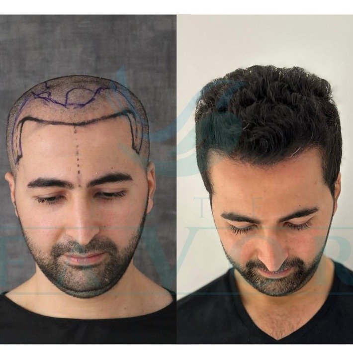 Top 10 Beste Haartransplantation Kliniken in der Türkei