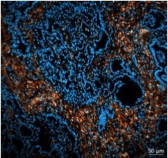 Tumorforschung: Neue Radioimmunotherapie macht aggressive und bislang schwer behandelbare Krebsarten (wieder) angreifbar