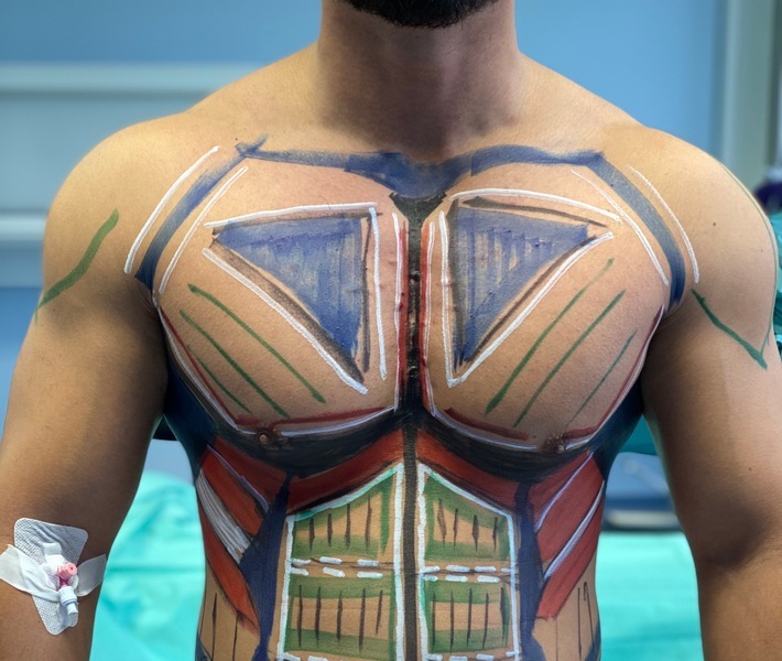 Haute Couture Medizin Behandlung 
Sixpack OP - Körperformung Weiterer Text über ots und www.presseportal.de/nr/143391 / Die Verwendung dieses Bildes ist für redaktionelle Zwecke honorarfrei. Veröffentlichung bitte unter Quellenangabe: "obs/Mc Aesthetics UG/Sylvia Kaduk"