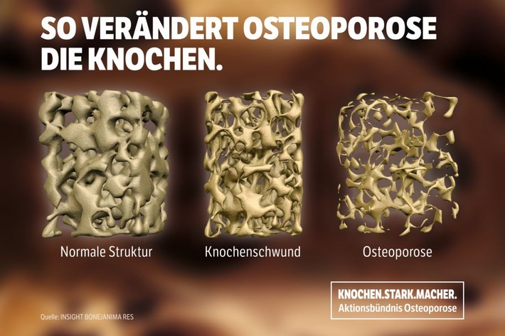 Osteoporose? - Da können Sie etwas tun!