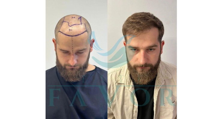 Die 10 besten Haartransplantationskliniken in der Türkei - Risiken, Sicherheit & Qualität