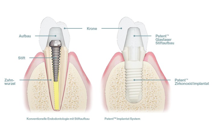 Hansgrohe-Gründerfamilie investiert in innovative Zahnimplantat-Technologie von Zircon Medical