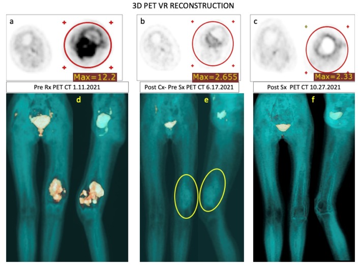 The world&#039;s first Extended Isolated Stopflow Limb Infusion (EISLI) to treat osteosarcoma results in complete remission