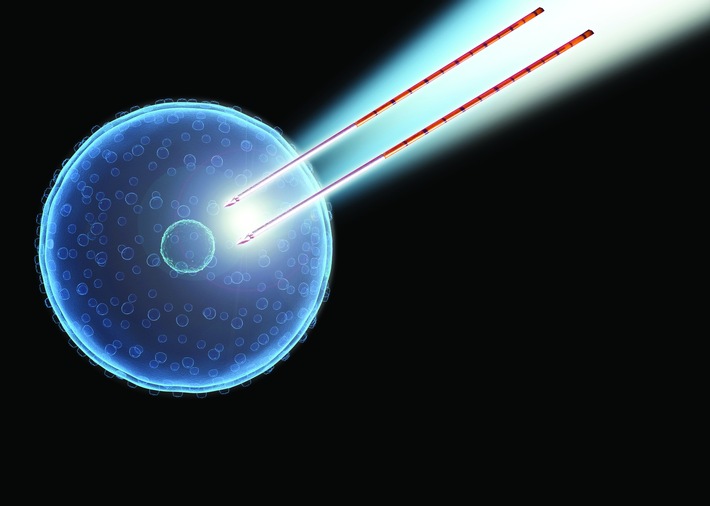 Bei der IRE-Therapie bildet sich um die nadelähnlichen Sonden ein gepulstes elektrisches Feld, das die Zellmembranen im Anwendungsbereich öffnet und damit die Zellen zerstört. Da es bei diesem Verfahren zu keiner Hitzeentwicklung kommt, kann sich das gesunde Gewebe erholen, während die Krebszellen absterben. Weiterer Text über ots und www.presseportal.de/nr/57328 / Die Verwendung dieses Bildes ist für redaktionelle Zwecke honorarfrei. Veröffentlichung bitte unter Quellenangabe: "obs/Klinik für Prostata-Therapie Heidelberg/Prostata-Therapie/AngioDynamics"