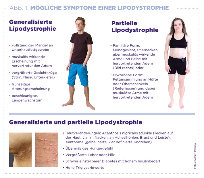 Welt-Lipodystrophie-Tag am 31. März / Keine Fettzellen - klingt gut, ist es aber nicht