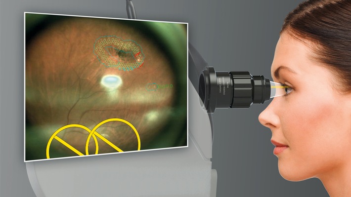 OD-OS GmbH at ESCRS 2023: Recent MDR certification of Navilas® underlines its advanced standard in retina lasers and opens path to new developments