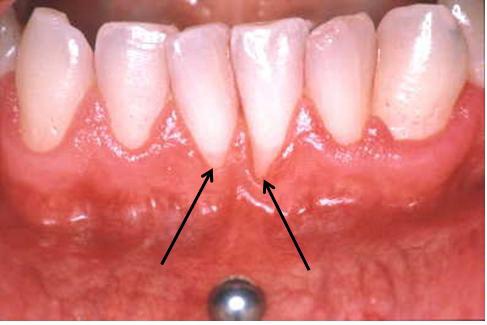 Piercing de la bouche : un bijou aux conséquences nocives