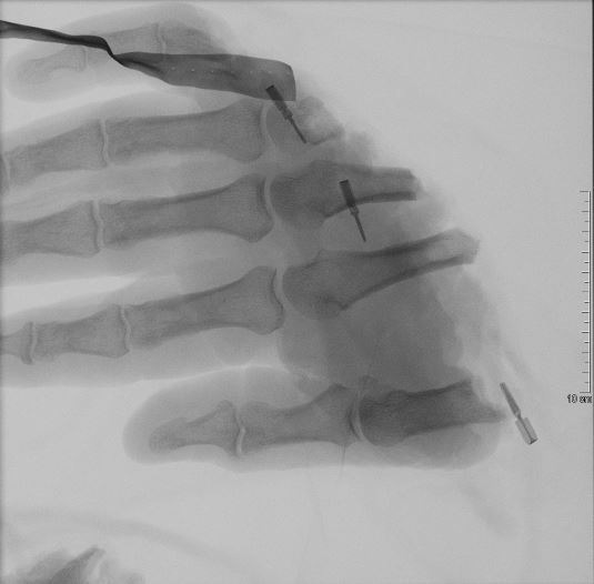 Abgetrennte Hand Röntgenbild 1.JPG