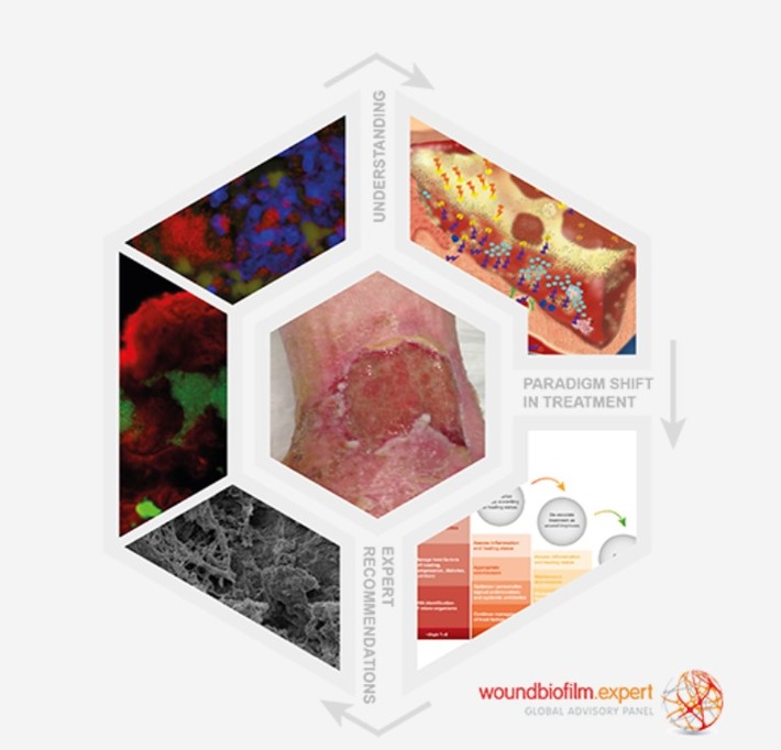 Panel di esperti per i Biofilm nelle ferite*: i Biofilm, responsabili di un ritardo nella guarigione delle ferite, si formano molto più frequentemente di quanto si sia finora supposto