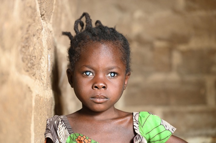 Einfache Operation, großes Wunder / Christoffel-Blindenmission schenkt Kindern Augenlicht