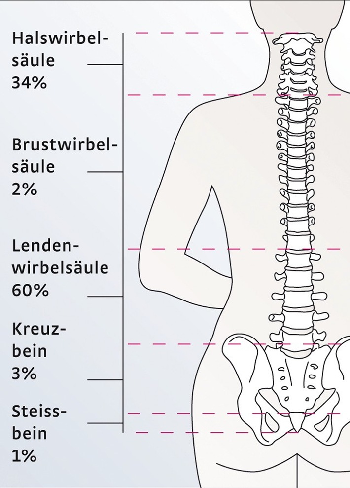 Rückenschmerzen - fast eine Epidemie in Industriestaaten (mit Bild)