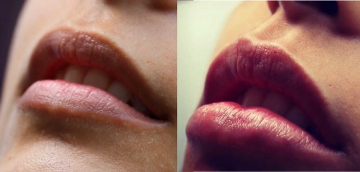 Bespoke Lippen aufspritzen -  nach der Corona Zeit 2020