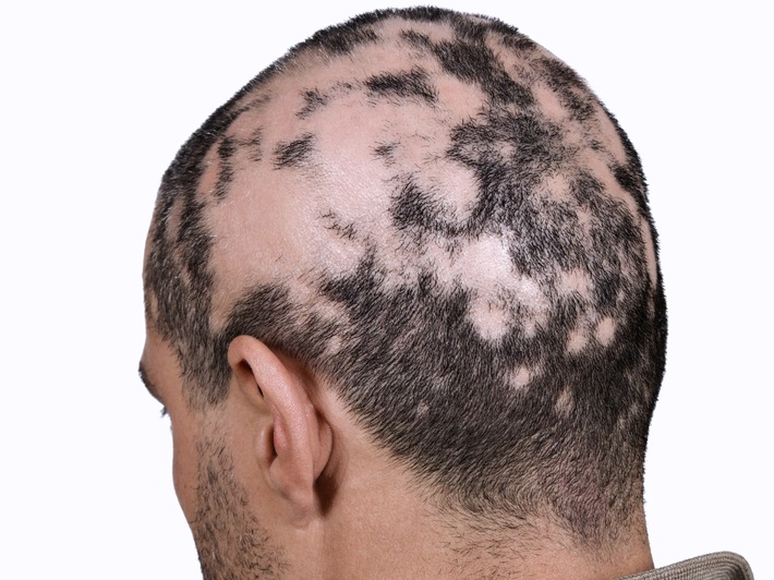 Mehr als ein ästhetisches Problem: Kreisrunder Haarausfall in schweren Formen behandlungsbedürftig / Tag der Immunologie 2023: Alopecia areata &quot;verkannte&quot; Autoimmunerkrankung?