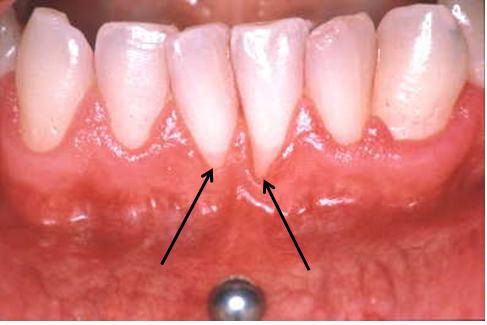 Piercing de la bouche : un bijou aux conséquences nocives