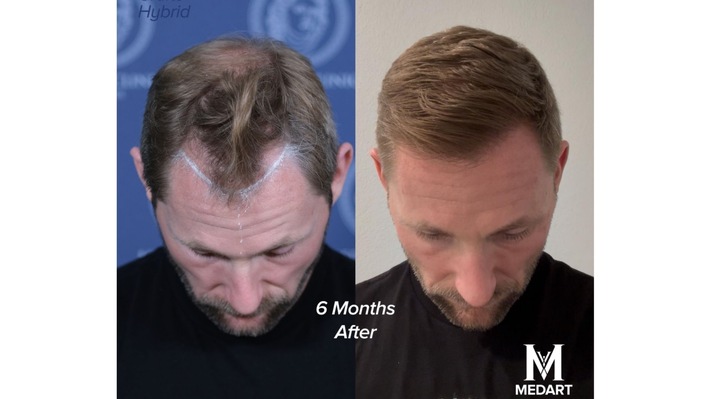 Haartransplantation Türkei Kosten: Der komplette Preisvergleich