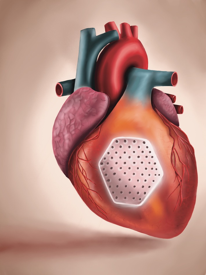 Update vom AHA 2025 zur Therapie fortgeschrittener Herzinsuffizienz / Positive klinische Ergebnisse zum Einsatz des Herzpflasters
