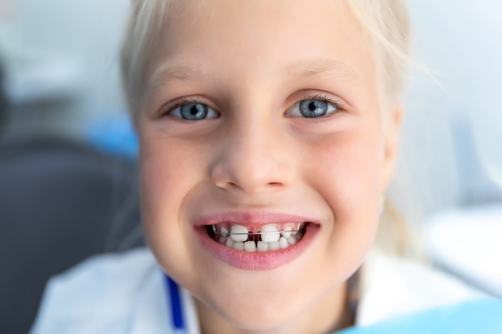Zahnschiefstand bei Kindern - nicht immer schlimm / Eine Frühbehandlung bei Kindern im Grundschulalter ist nur in Ausnahmefällen nötig
