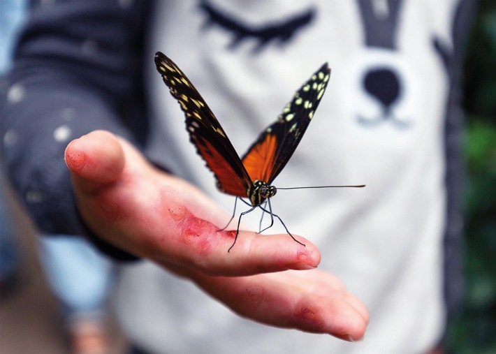 RHEACELL verkündet "First Patient In": EB-Haus in Salzburg, Österreich startet die von Betroffenen ersehnte Zulassungsstudie einer Stammzelltherapie für schwere Formen der Epidermolysis bullosa