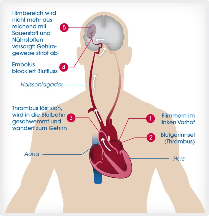 Neun von zehn befragten Patienten mit Vorhofflimmern sorgen sich um ihr Schlaganfallrisiko und wollen in Therapieentscheidungen einbezogen werden (FOTO)