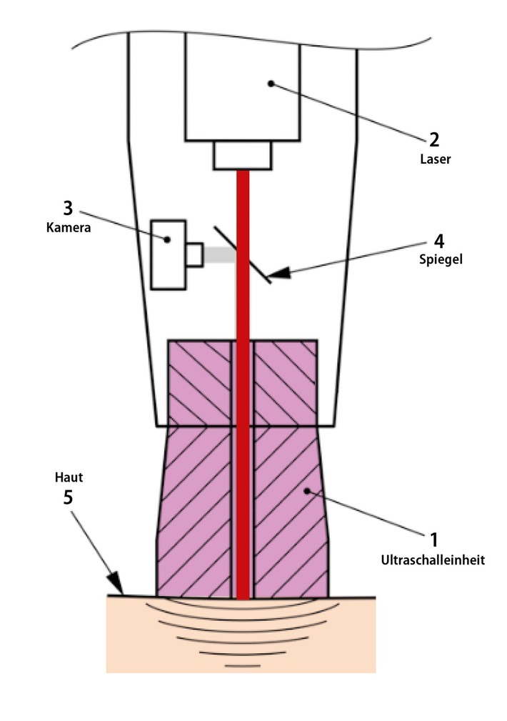 Tätowierungen entfernen mit Laser und Ultraschall