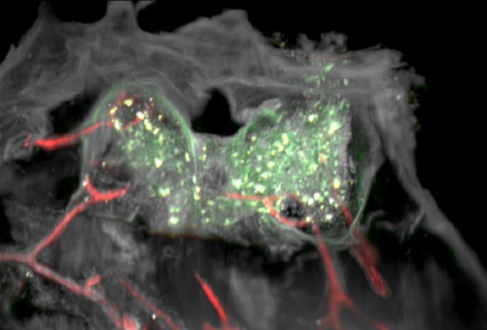 Überraschender Fund bei Glioblastomen: Inseln potenter Abwehrzellen im lokalen Knochenmark