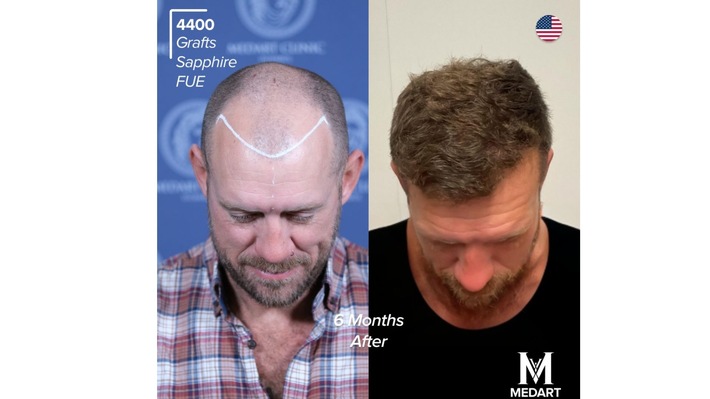 Die 10 Besten Haartransplantationszentren in der Türkei: Schmerzen, Komfort und häufige Patientenfragen