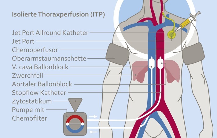 Schema der Isolierten Thoraxperfusion mit intra-arterieller Kurzzeitinufsion via arteriellen Portkatheter. Aufgrund des reduzierten Blutvolumens sind Tumore höheren Konzentrationen von Zytostatika ausgesetzt. Weiterer Text über ots und www.presseportal.de/nr/143407 / Die Verwendung dieses Bildes ist für redaktionelle Zwecke honorarfrei. Veröffentlichung bitte unter Quellenangabe: "obs/Medias Klinikum GmbH & Co KG"