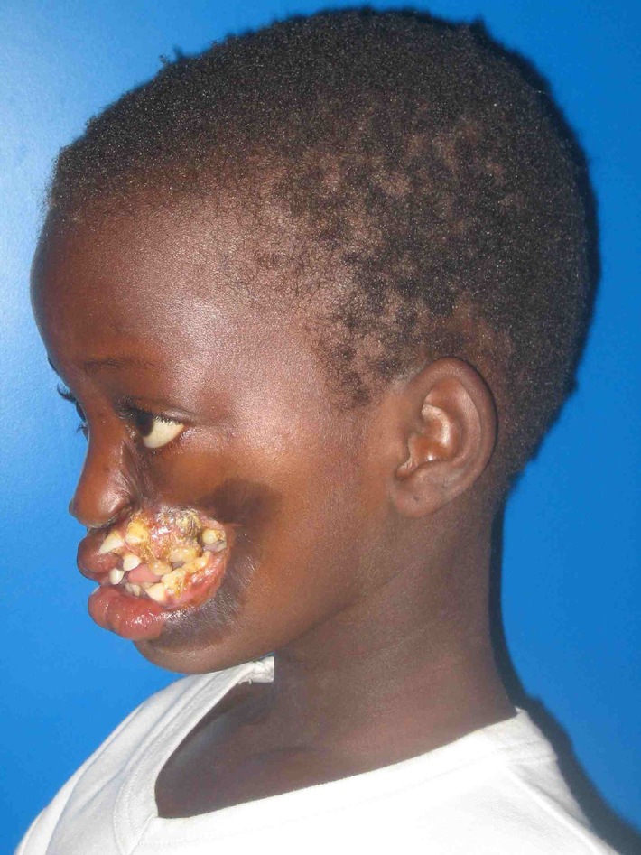 Société Suisse d&#039;Odonto-stomatologie: Le noma ravage le visage des enfants